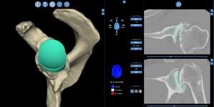 Planning for Dr. Louthan’s total shoulder replacement surgery was an in-depth process. For each shoulder replacement, Dr. Jacobsen maps out the surgery on his computer. Then, using imaging, he walks through each step of the surgery before he ever operates on a patient. 